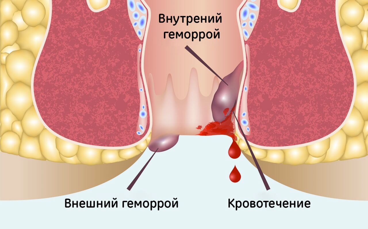 Зуд после туалета