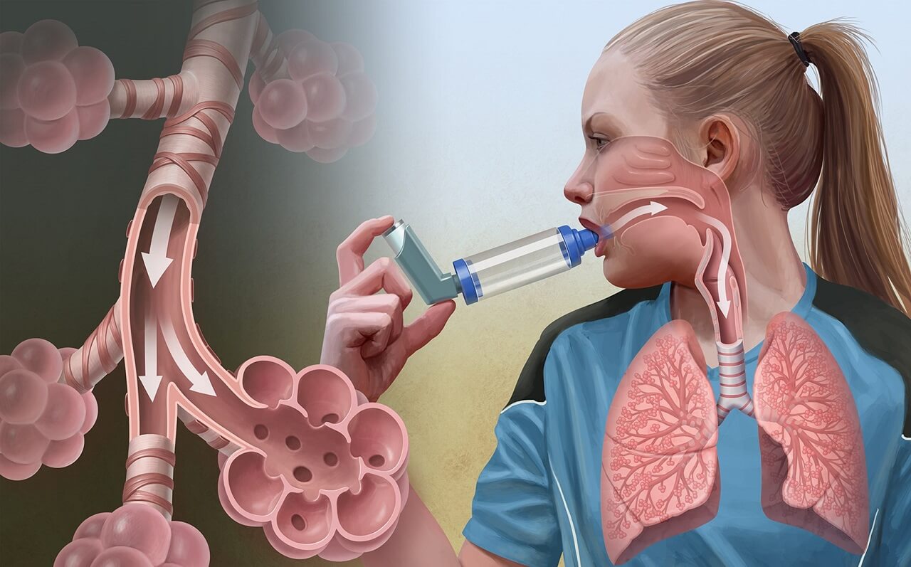 Заболевание астма лечение. Бронхиальная астма. Болезнь бронхиальная астма. Бронхи при бронхиальной астме.