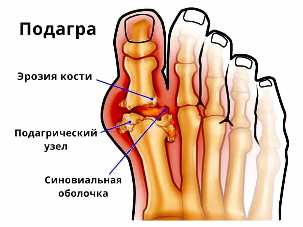 Подагра